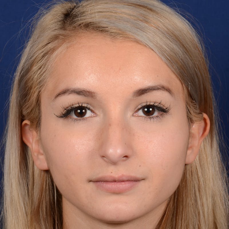 Female Rhinoplasty Before & After Gallery - Patient 943676 - Image 1