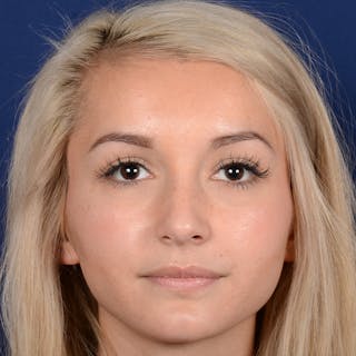 Female Rhinoplasty Before & After Gallery - Patient 943676 - Image 2