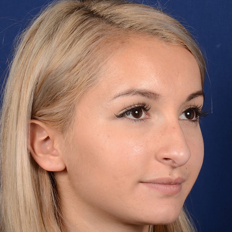 Female Rhinoplasty Before & After Gallery - Patient 943676 - Image 3