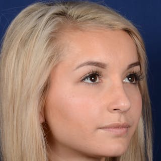 Female Rhinoplasty Before & After Gallery - Patient 943676 - Image 4