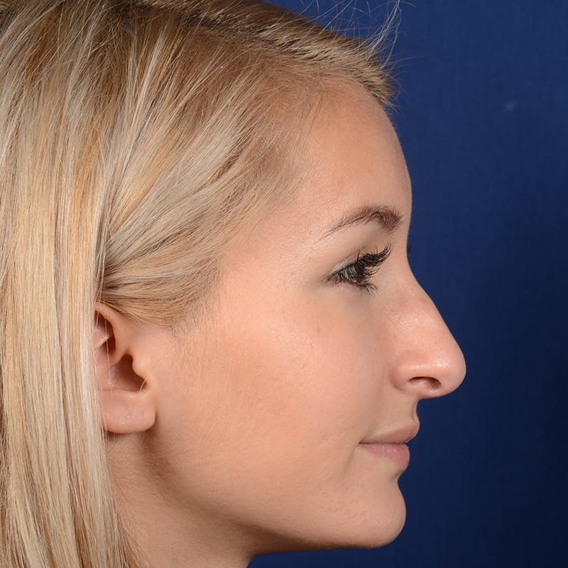 Female Rhinoplasty Before & After Gallery - Patient 943676 - Image 5