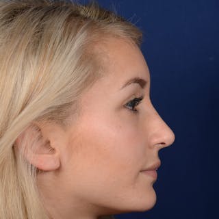 Female Rhinoplasty Before & After Gallery - Patient 943676 - Image 6