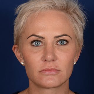 Female Rhinoplasty Before & After Gallery - Patient 131995 - Image 2