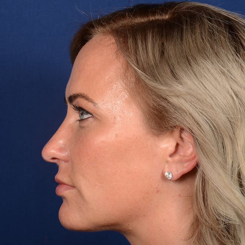 Female Rhinoplasty Before & After Gallery - Patient 131995 - Image 5