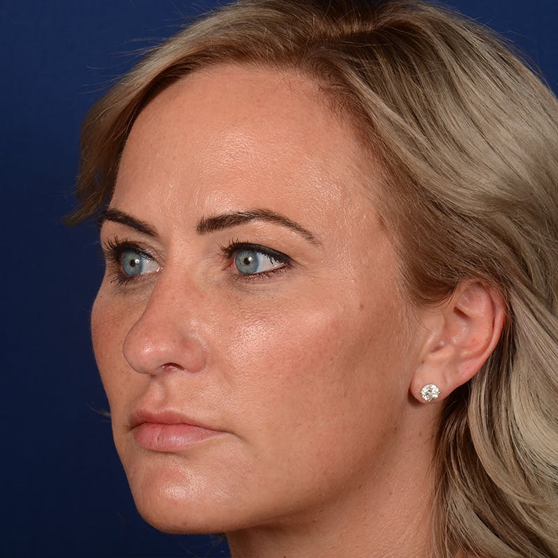 Female Rhinoplasty Before & After Gallery - Patient 131995 - Image 3