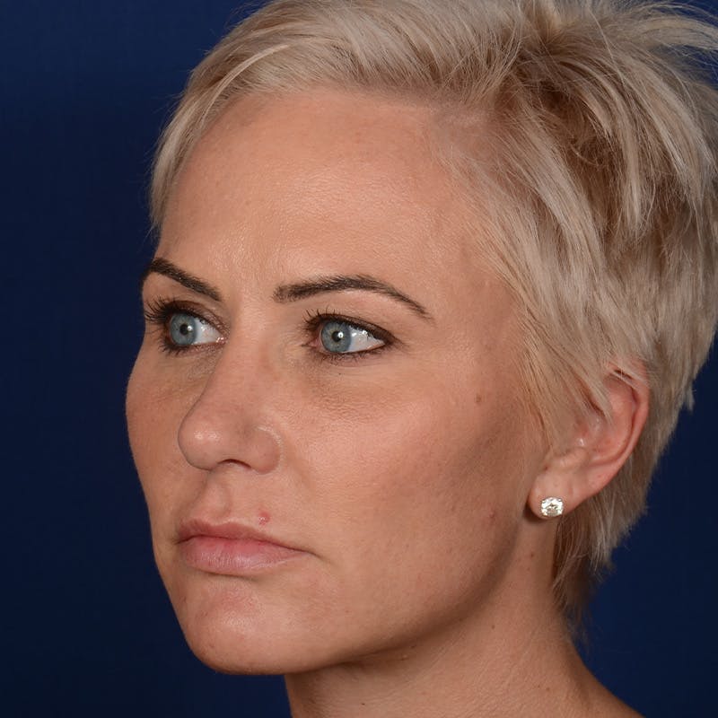 Female Rhinoplasty Before & After Gallery - Patient 131995 - Image 4