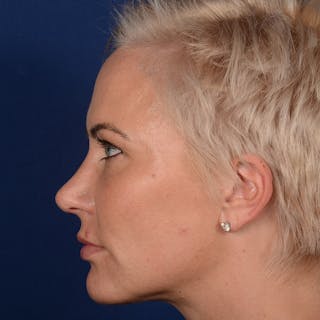 Female Rhinoplasty Before & After Gallery - Patient 131995 - Image 6