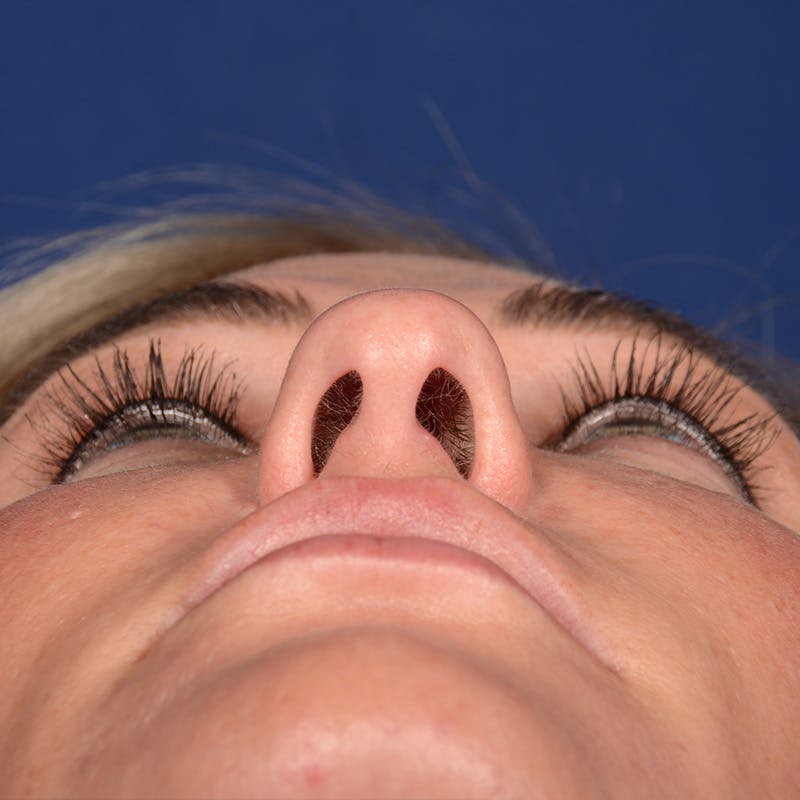 Female Rhinoplasty Before & After Gallery - Patient 131995 - Image 7