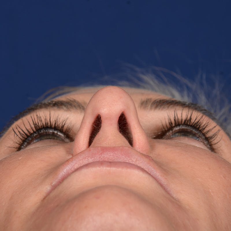 Female Rhinoplasty Before & After Gallery - Patient 131995 - Image 8