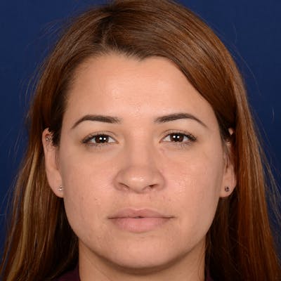 Female Rhinoplasty Before & After Gallery - Patient 610879 - Image 1