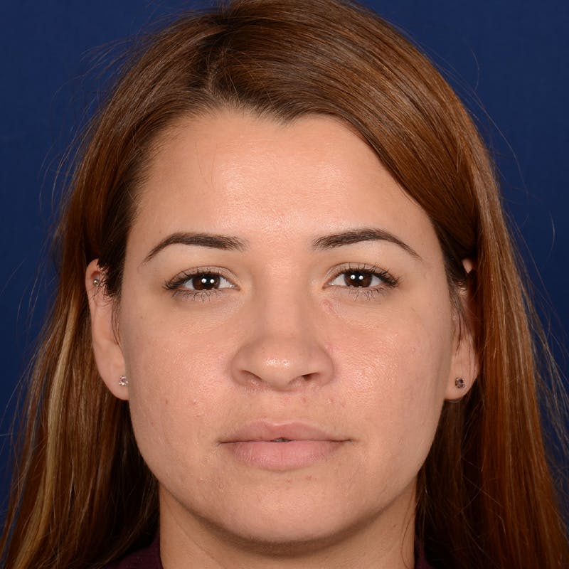 Female Rhinoplasty Before & After Gallery - Patient 610879 - Image 1