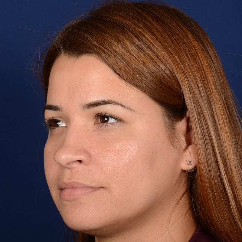 Female Rhinoplasty Before & After Gallery - Patient 610879 - Image 3