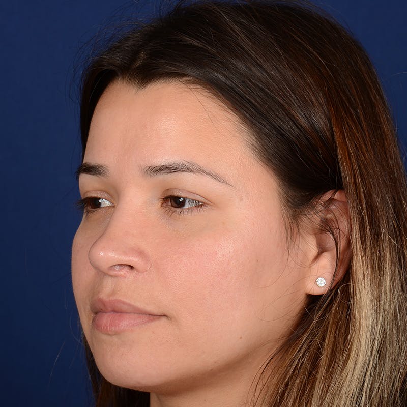 Female Rhinoplasty Before & After Gallery - Patient 610879 - Image 4