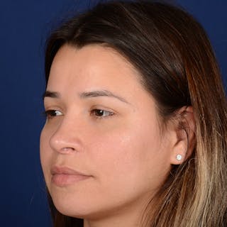 Female Rhinoplasty Before & After Gallery - Patient 610879 - Image 4