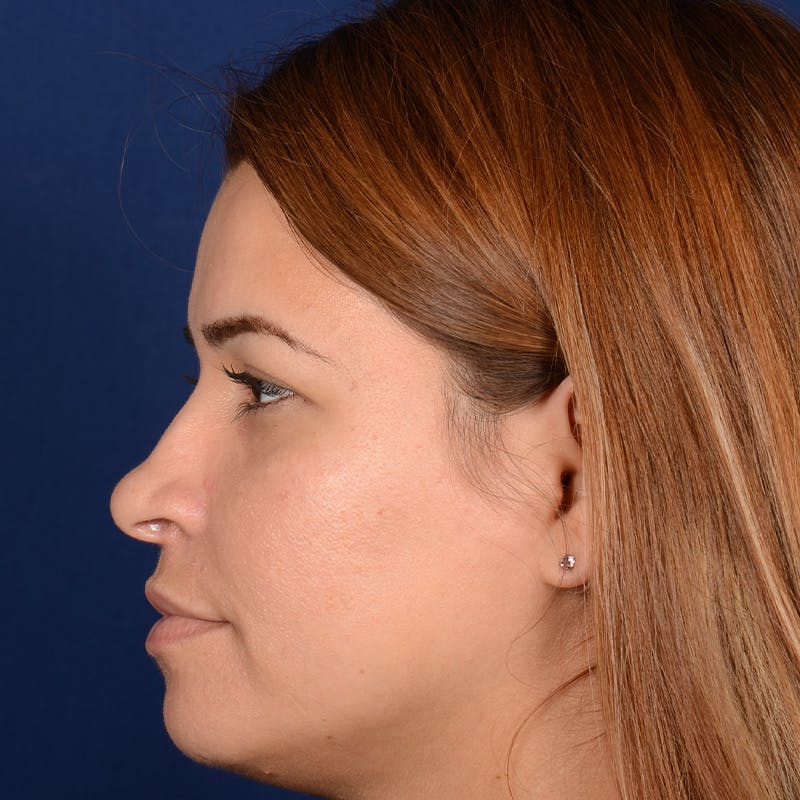 Female Rhinoplasty Before & After Gallery - Patient 610879 - Image 5