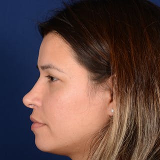 Female Rhinoplasty Before & After Gallery - Patient 610879 - Image 6