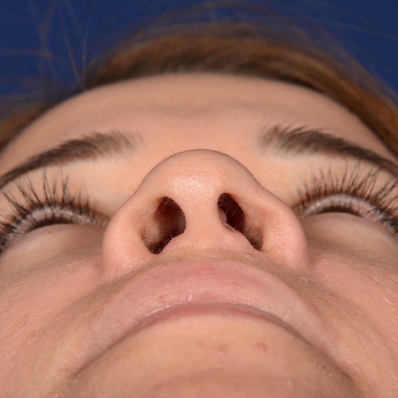 Female Rhinoplasty Before & After Gallery - Patient 610879 - Image 7