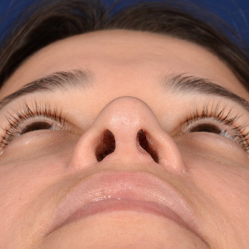 Female Rhinoplasty Before & After Gallery - Patient 610879 - Image 8