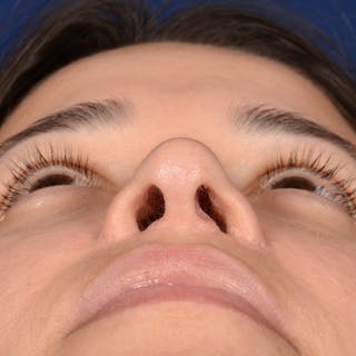 Female Rhinoplasty Before & After Gallery - Patient 610879 - Image 8