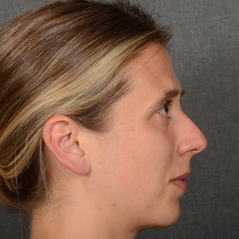 Female Rhinoplasty Before & After Gallery - Patient 361996 - Image 5