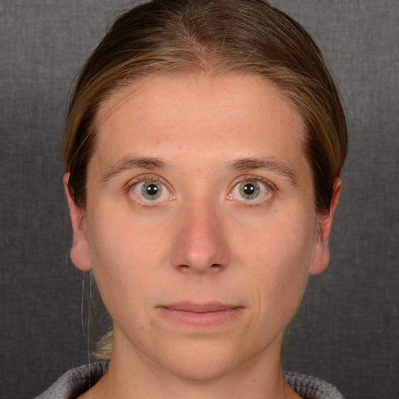 Female Rhinoplasty Before & After Gallery - Patient 361996 - Image 1
