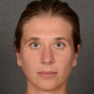 Female Rhinoplasty Before & After Gallery - Patient 361996 - Image 2