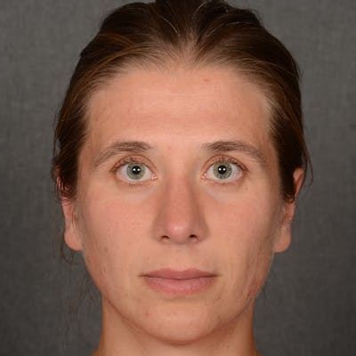 Rhinoplasty w/ Chin Implant Before & After Gallery - Patient 128107 - Image 2