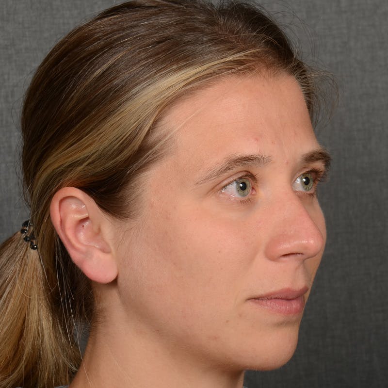 Female Rhinoplasty Before & After Gallery - Patient 361996 - Image 3