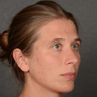 Female Rhinoplasty Before & After Gallery - Patient 361996 - Image 4
