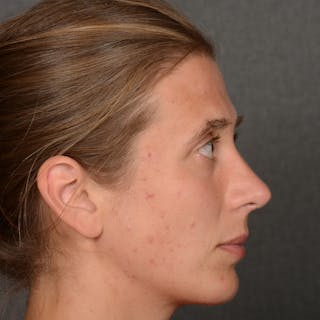Female Rhinoplasty Before & After Gallery - Patient 361996 - Image 6
