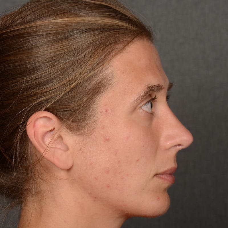 Female Rhinoplasty Before & After Gallery - Patient 361996 - Image 6