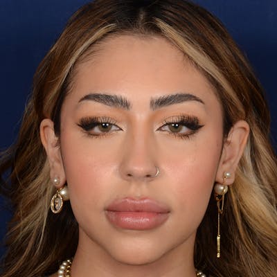 Female Rhinoplasty Before & After Gallery - Patient 219194 - Image 1