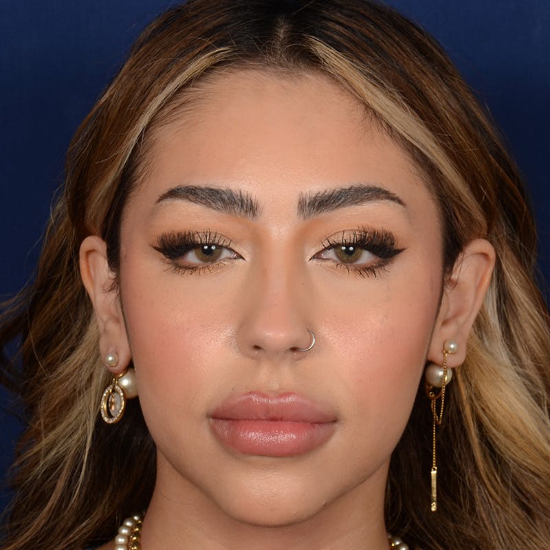 Female Rhinoplasty Before & After Gallery - Patient 219194 - Image 1