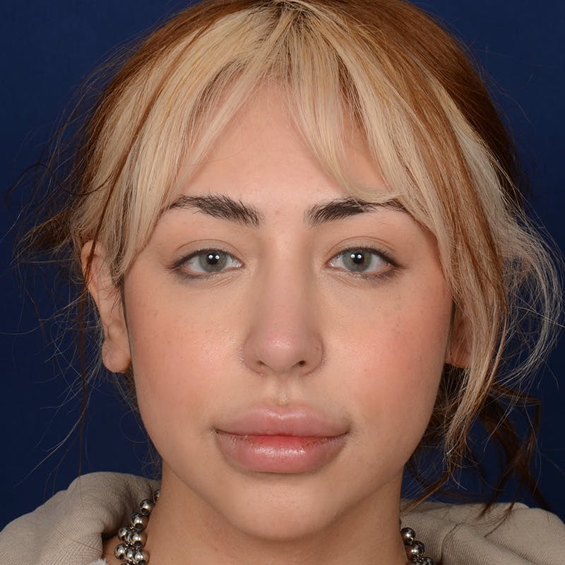 Female Rhinoplasty Before & After Gallery - Patient 219194 - Image 2