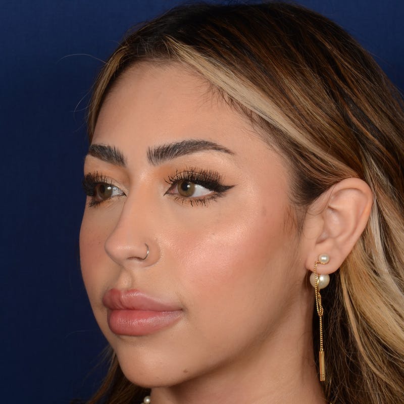 Female Rhinoplasty Before & After Gallery - Patient 219194 - Image 3