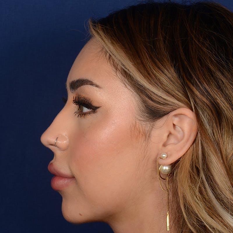Female Rhinoplasty Before & After Gallery - Patient 219194 - Image 5