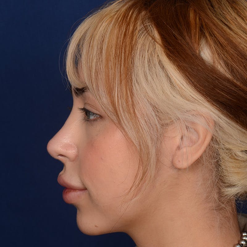 Female Rhinoplasty Before & After Gallery - Patient 219194 - Image 6
