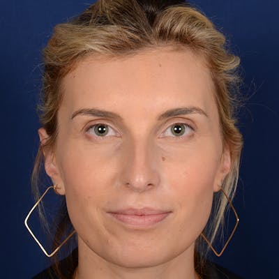 Female Rhinoplasty Before & After Gallery - Patient 178992 - Image 1