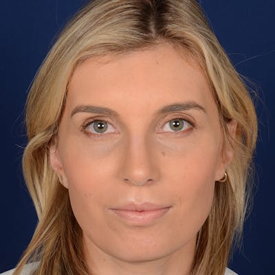 Female Rhinoplasty Before & After Gallery - Patient 178992 - Image 2