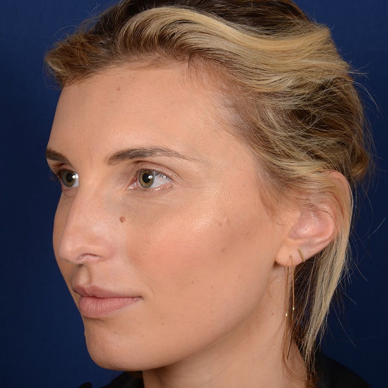 Female Rhinoplasty Before & After Gallery - Patient 178992 - Image 3