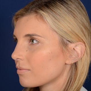 Female Rhinoplasty Before & After Gallery - Patient 178992 - Image 4