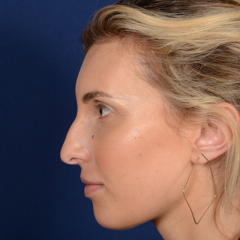 Female Rhinoplasty Before & After Gallery - Patient 178992 - Image 5