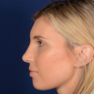 Female Rhinoplasty Before & After Gallery - Patient 178992 - Image 6