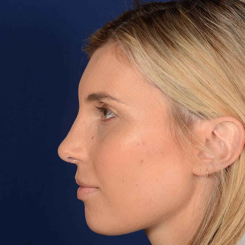 Female Rhinoplasty Before & After Gallery - Patient 178992 - Image 6