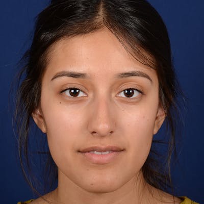 Female Rhinoplasty Before & After Gallery - Patient 415050 - Image 1