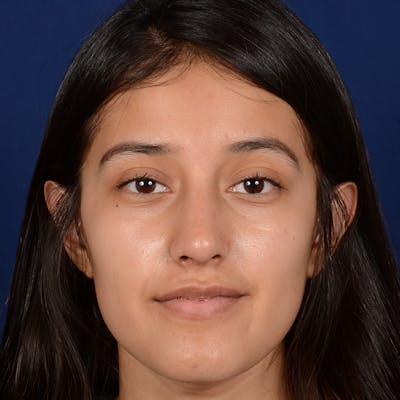 Female Rhinoplasty Before & After Gallery - Patient 415050 - Image 2