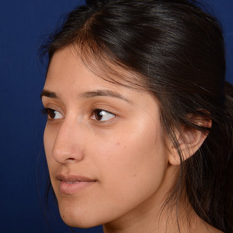 Female Rhinoplasty Before & After Gallery - Patient 415050 - Image 5