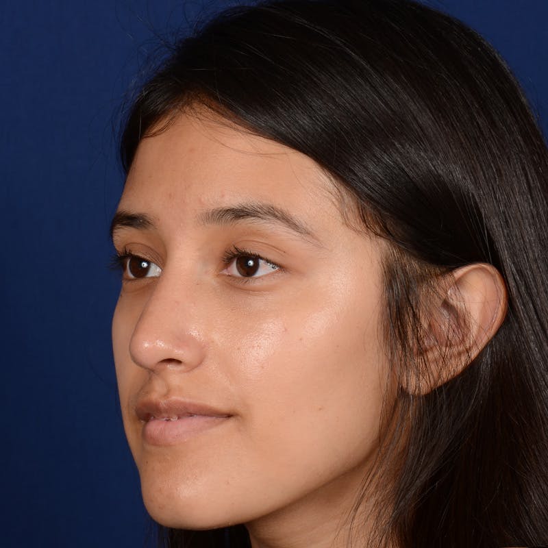 Female Rhinoplasty Before & After Gallery - Patient 415050 - Image 6