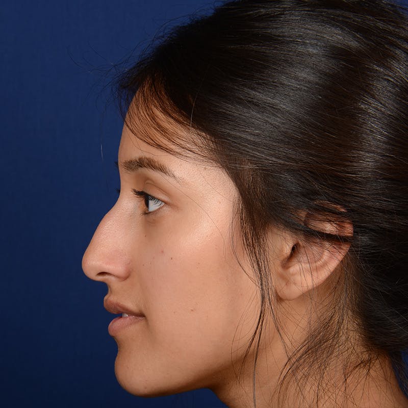 Female Rhinoplasty Before & After Gallery - Patient 415050 - Image 3