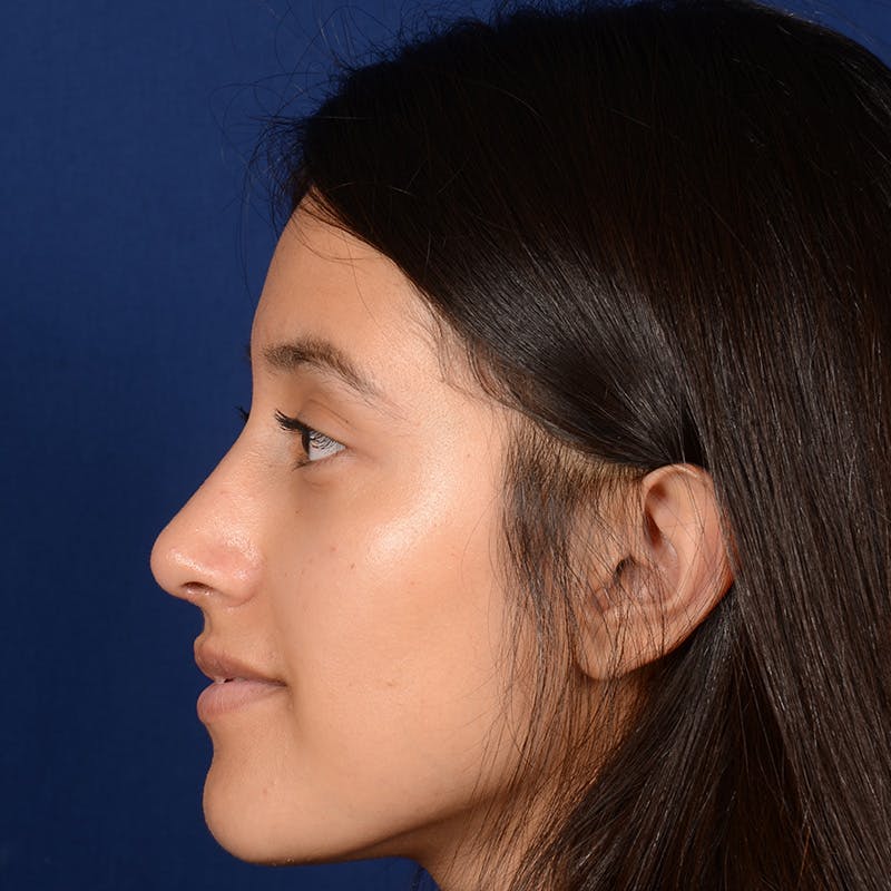 Female Rhinoplasty Before & After Gallery - Patient 415050 - Image 4